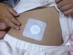 小兒積滯，秘密武器來幫你——敷貼器